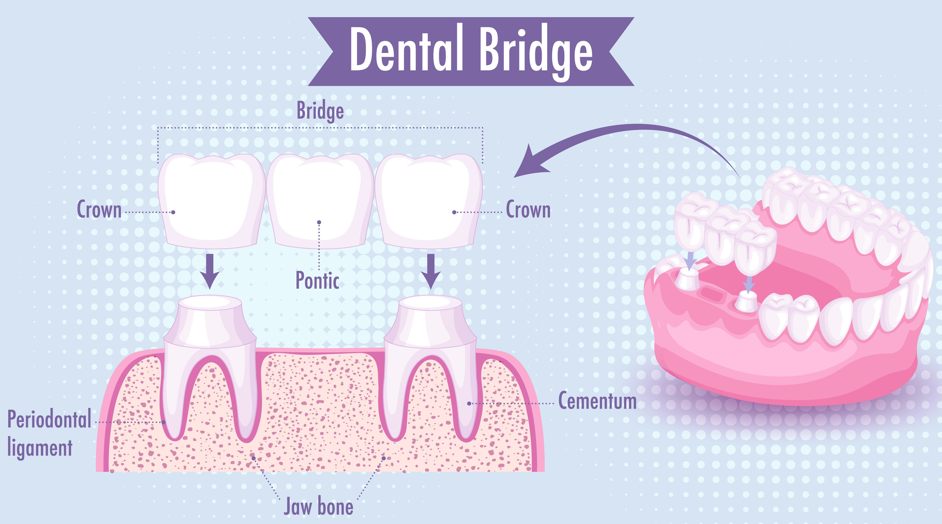 Dental Bridge