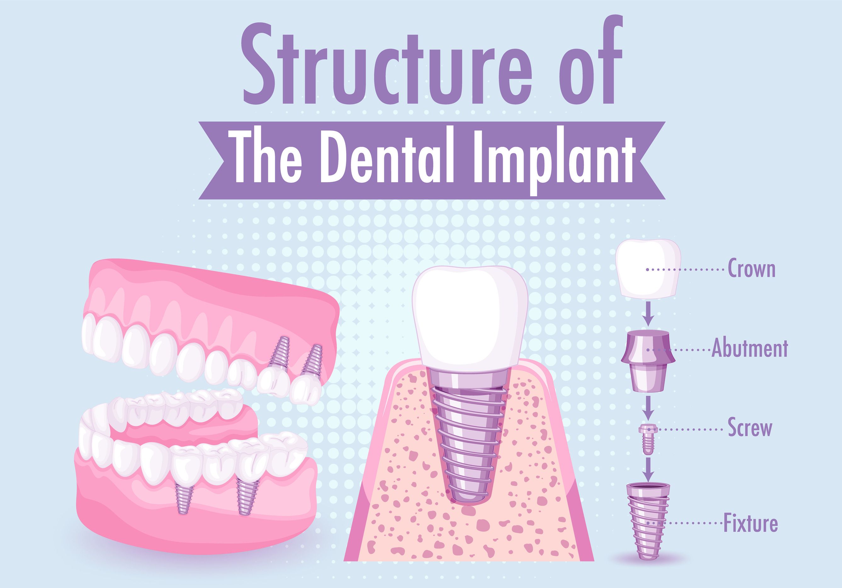 Implants