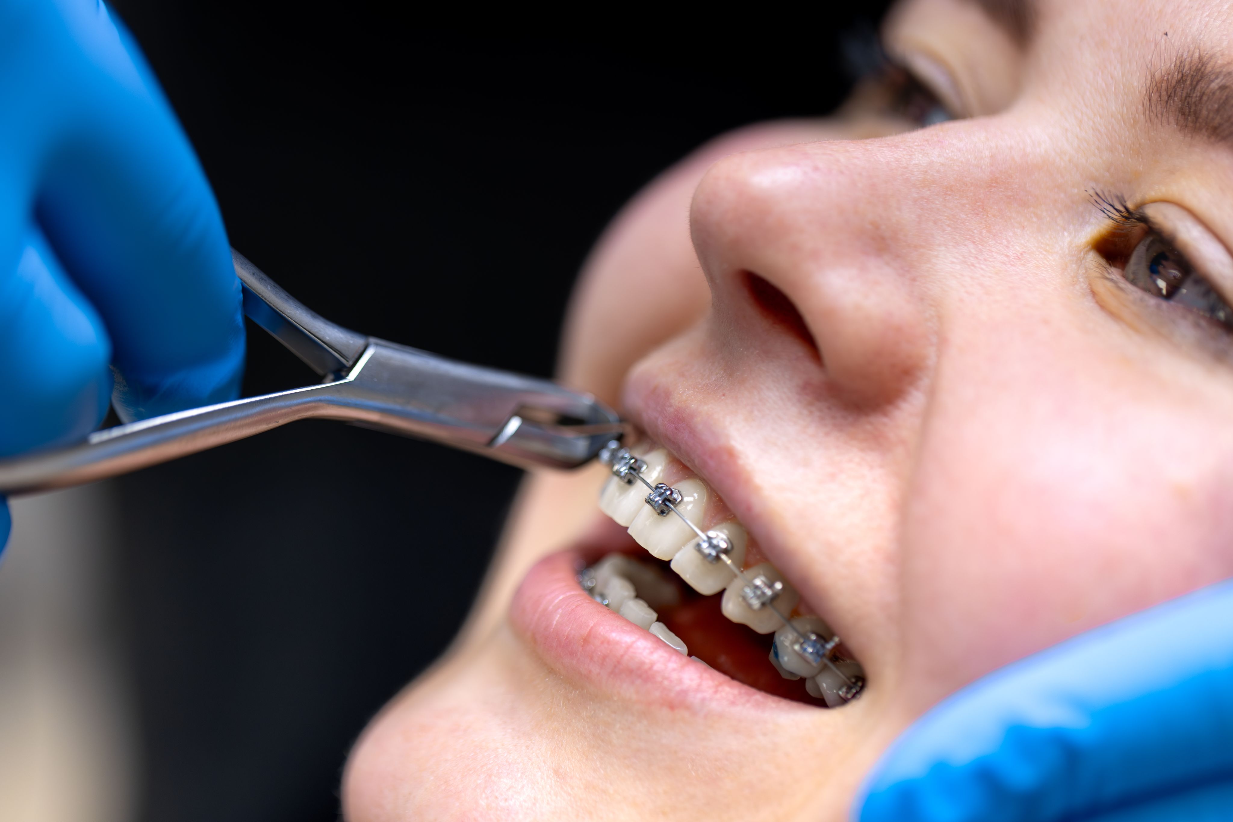 Braces