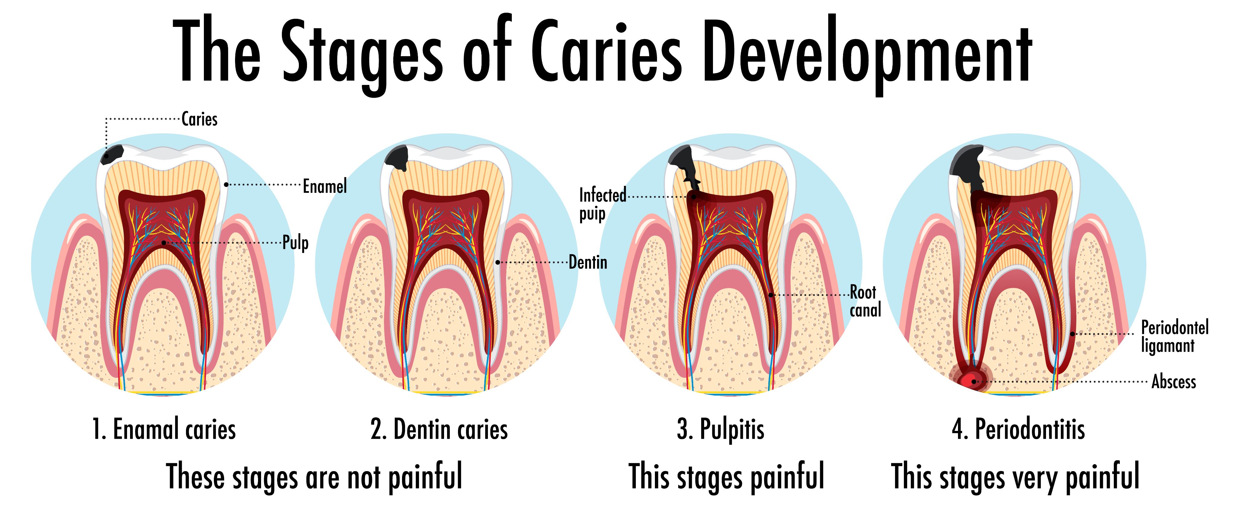 Root Canal