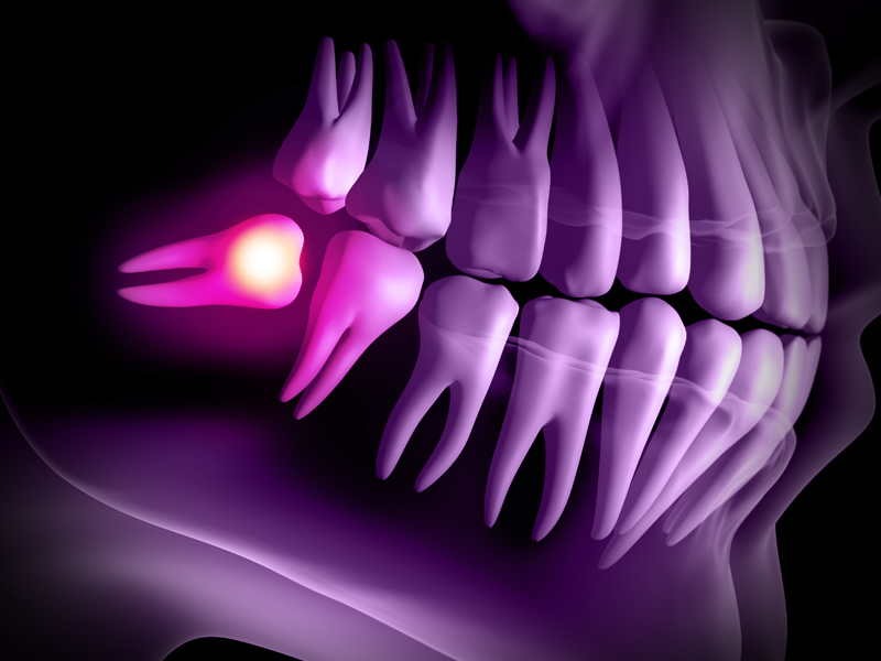 Wisdom Tooth